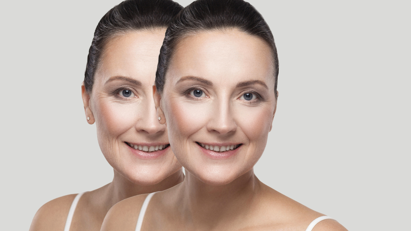 Non Invasive Skin Tightening And Lifting With Ultherapy At Invogue