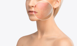 Skin Resurfacing | InVogue Rejuvenation